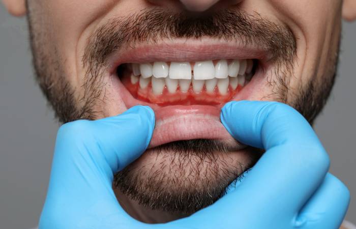 Gum-Disease