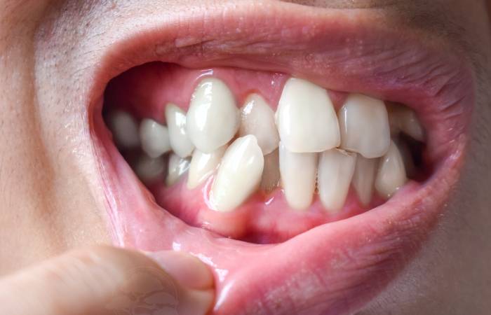 Teeth Misalignment