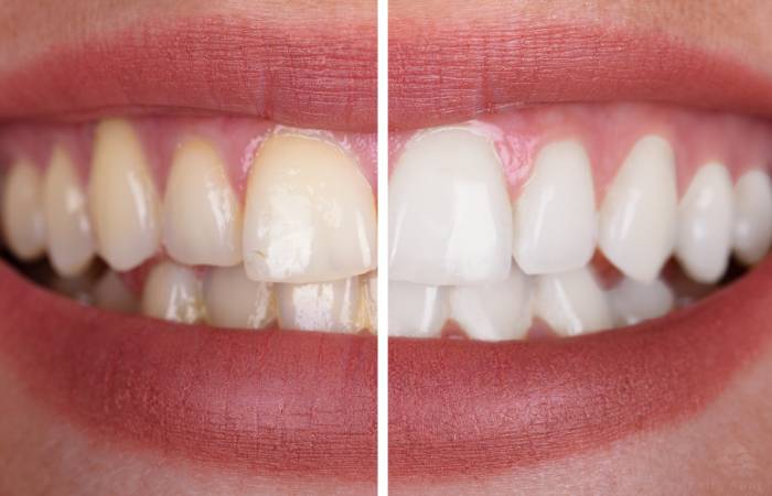 Whiter teeth 