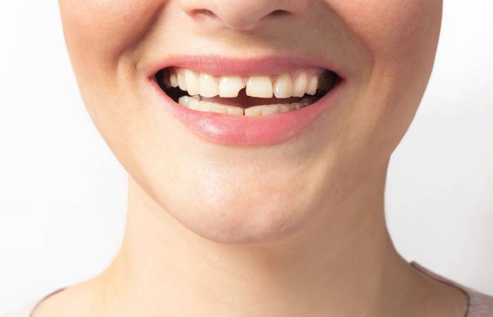 Chipped tooth