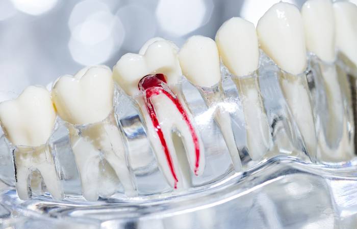 Root canal